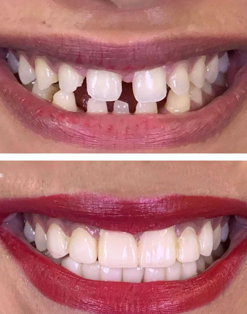 Gap Closure of Teeth